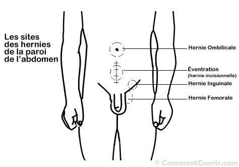 Ce que vous devez savoir sur les hernies